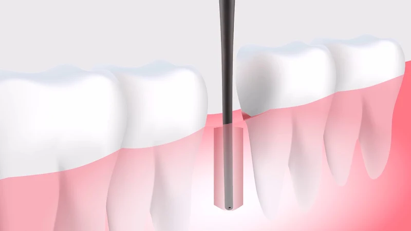 Excel Dental (Downtown East): Dental Implants | Wisdom Tooth Surgery | Specialist Dental Care photo 2